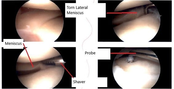 Intraoperative arthroscopic image showing the meniscus tear.