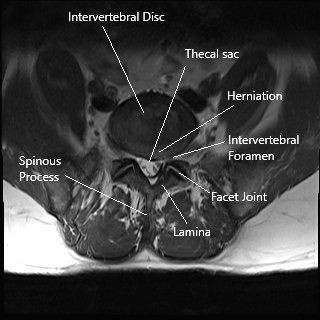 Axial section of the lumbar MRI showing a herniated intervertebral disc compressing the thecal sac and narrowing the intervertebral foramen.