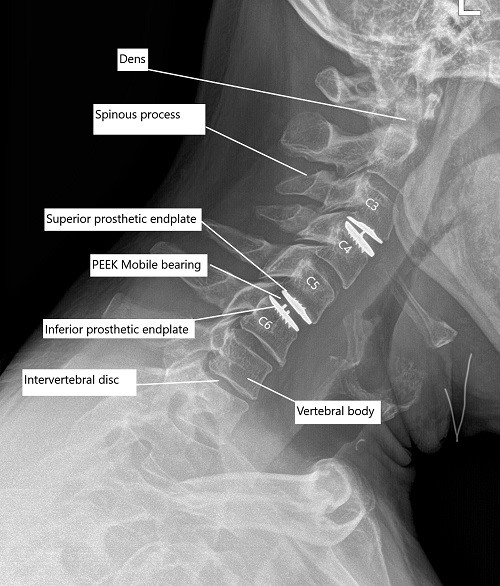 Radiografía postoperatoria de la columna cervical que muestra reemplazo total de disco cervical a nivel C3-C4 y C5-C6.