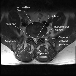 Sección axial de resonancia magnética de la columna lumbar que muestra estenosis foraminal.