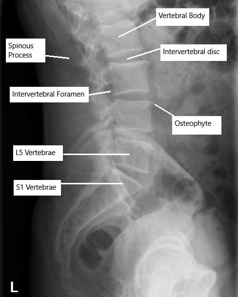 Radiografía de la columna lumbar que muestra cambios degenerativos.