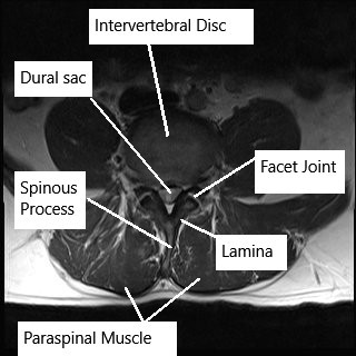 MRI of the lumbar spine in axial section.