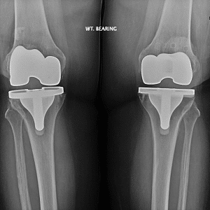 Radiografía de reemplazo de articulaciones