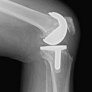 knee-xray