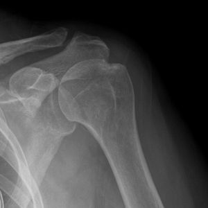 shoulder-xray