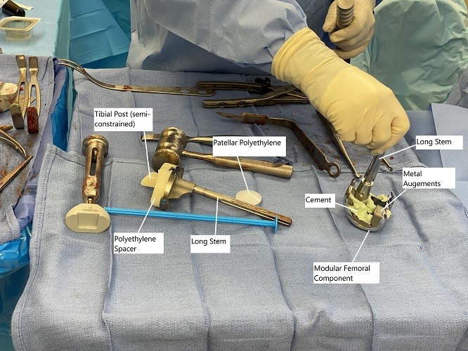 Intraoperative image showing modular knee replacement implants.