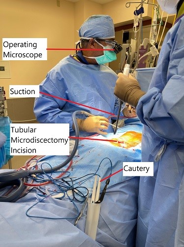 Imagen intraoperatoria que muestra microdiscectomía tubular.