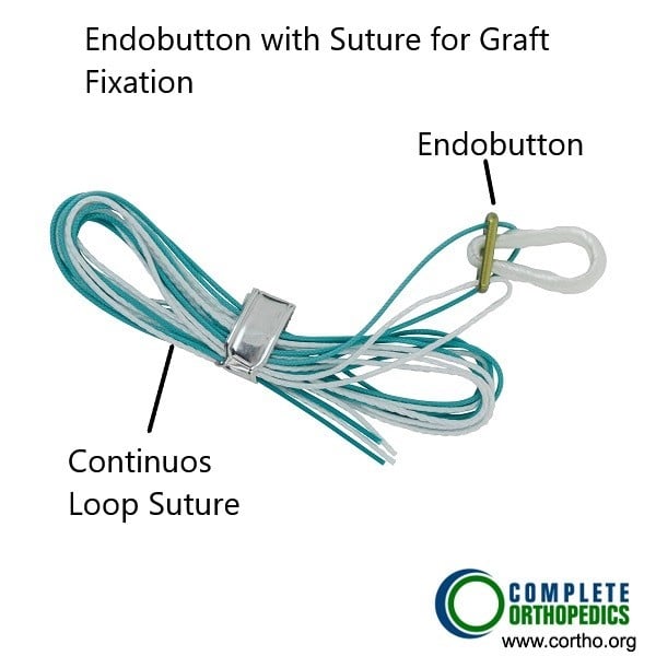 Endobutton utilizado para asegurar el injerto de LCA.