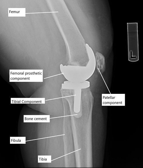 X-ray showing total knee replacement.