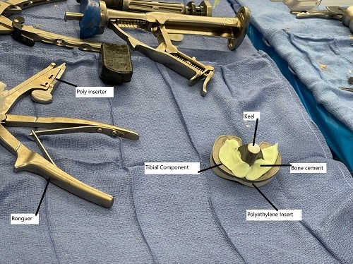 Intraoperative image showing cementing of the tibial component.