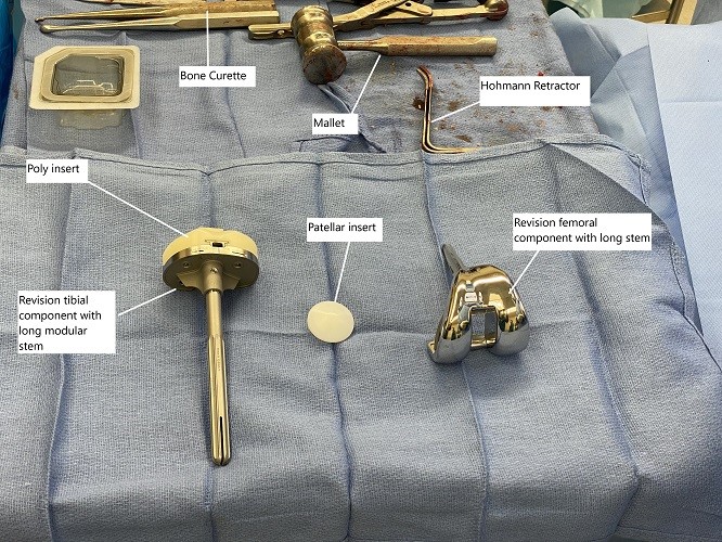 Implantes intraoperatorios e instrumentos utilizados en la cirugía de revisión de rodilla.