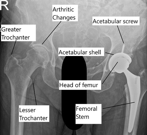 Radiografía que muestra una cirugía de reemplazo total de cadera.