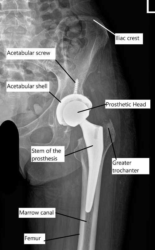 X-ray showing a total hip replacement.