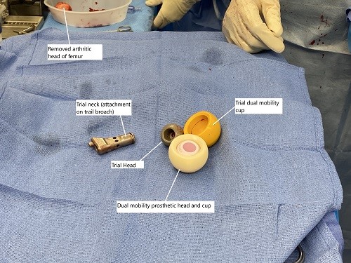 Imagen intraoperatoria que muestra un sistema de copa de doble movilidad utilizado para una mayor estabilidad y prevención de luxaciones.