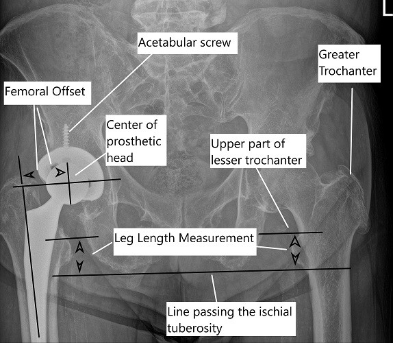 Radiografía de la pelvis que muestra la medición de la longitud de la pierna en un reemplazo total de cadera postoperatorio de la cadera derecha.