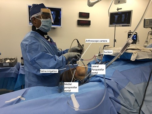 Intraoperative image showing arthroscopic repair of MPFL.