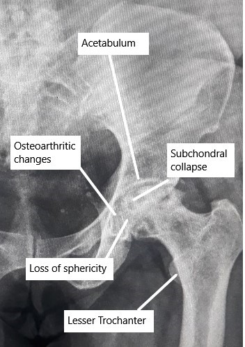 X-ray showing advanced AVN changes in the Hip.