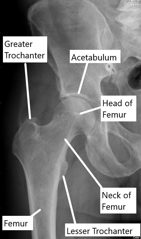 Radiografía que muestra la anatomía normal de la articulación de la cadera.