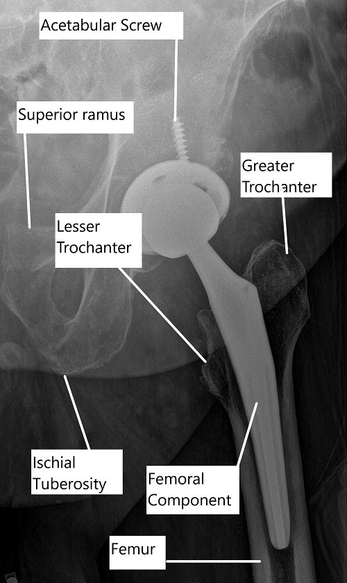 X-ray showing a total hip replacement.