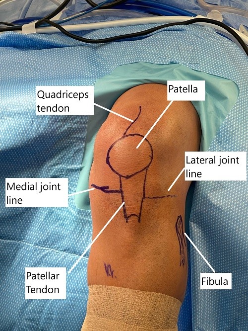 Marcas cutáneas intraoperatorias de la articulación de la rodilla antes de la reconstrucción artroscópica.