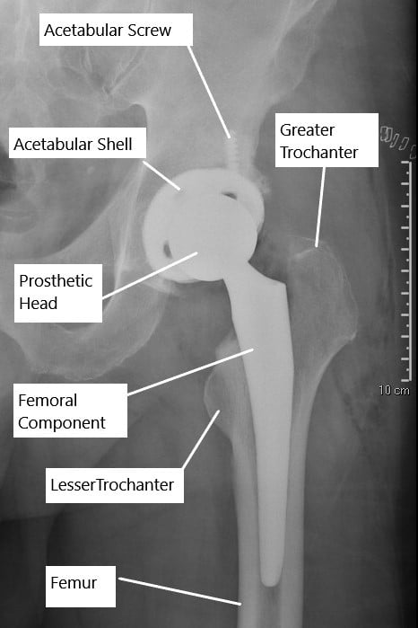 X-ray showing an uncemented total hip replacement.