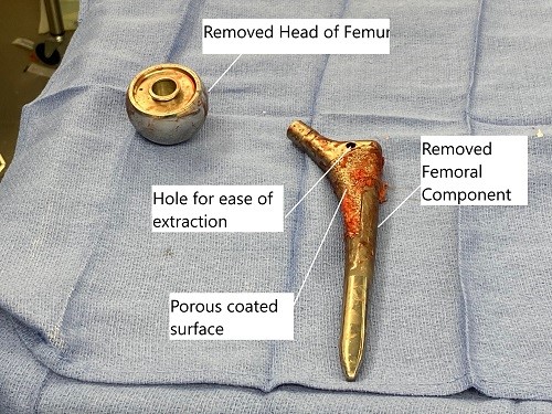 Extracted head of femur and the femoral component during revision surgery.