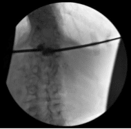 Fluoroscopic Imaging