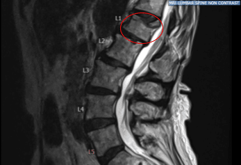 Pre-Operative X-ray