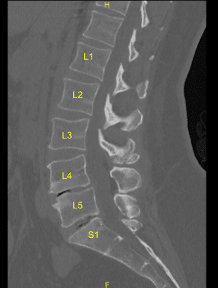 Spinal Fusion graph