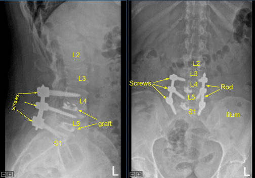 Spinal Fusion graph (3)