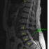 L4 and L5 Laminectomy with Neurolysis | Complete Orthopedics