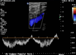 Doppler Venous Left Lower Extremity