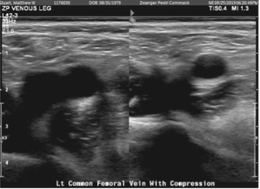 Doppler venous left lower extremity