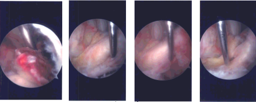 Intraoperative Arthroscopy Images 1