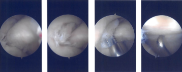 Imágenes de artroscopia intraoperatoria