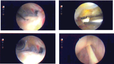 Intraoperative Arthroscopy Images