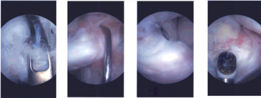 Intraoperative Arthroscopy Images