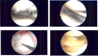 Intraoperative Arthroscopy Images