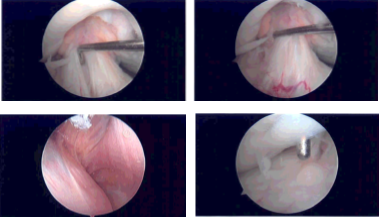 Intraoperative Arthroscopy Images