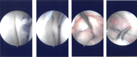 Intraoperative Arthroscopy Images