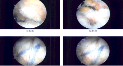 Intraoperative Arthroscopy Images