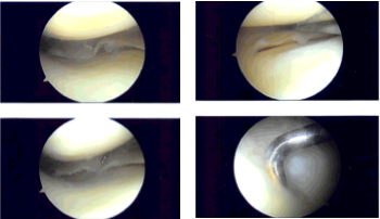 Intraoperative Arthroscopy Images