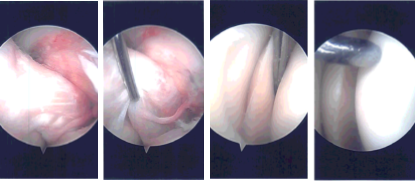 Intraoperative Arthroscopy Images