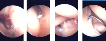 Intraoperative Arthroscopy Images