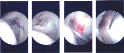 Intraoperative Arthroscopy Images