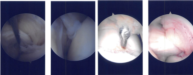 Imágenes de artroscopia intraoperatoria