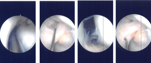 Intraoperative Arthroscopy Images