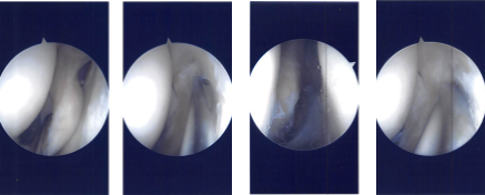 Intraoperative Arthroscopy Images