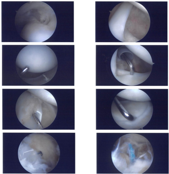 Intraoperative images