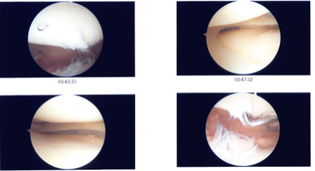 Intraoperative photo